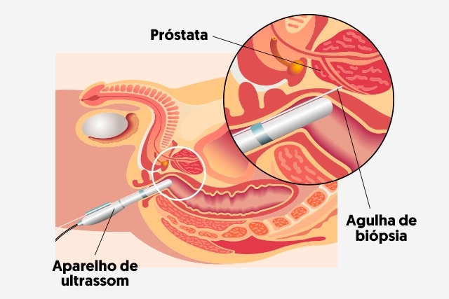 biopsia de prostata