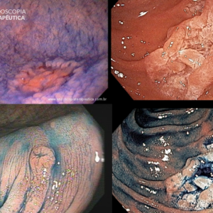 Utilização de corantes na Endoscopia